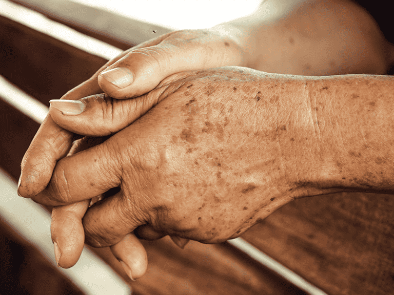 Age-spots-Large_0006_AdobeStock_81585490.png