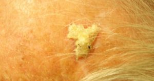 actinic-keratosis-300x158-1.jpg