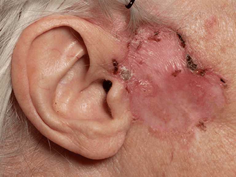 basalcellcarcinoma_0001_Basal-Cell-Carcinoma-5-large.png