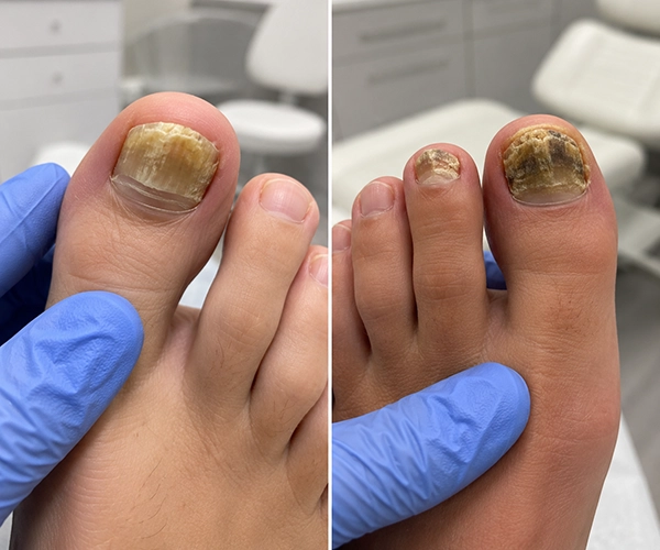 Fungal Nail Treatment with Laser | Kent Skin & Laser Clinic