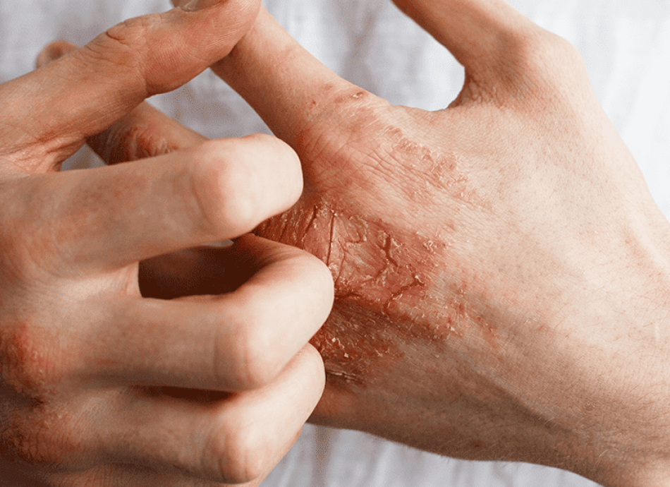 eczema_0002_AdobeStock_137327355.png